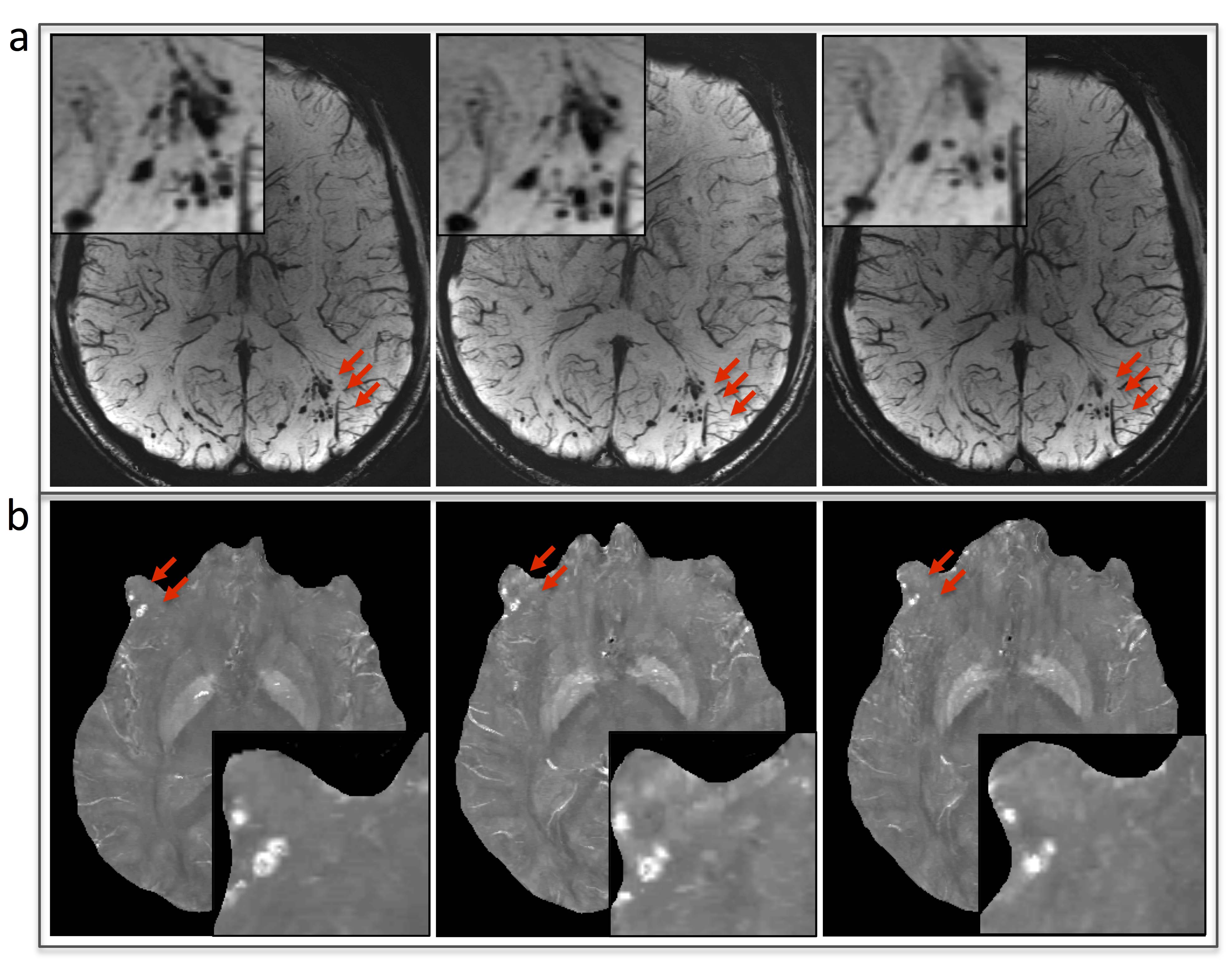 RSNA MRI Improves Diagnosis of Microbleeding after Brain Injury in
